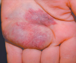 Vascular Malformations Hand